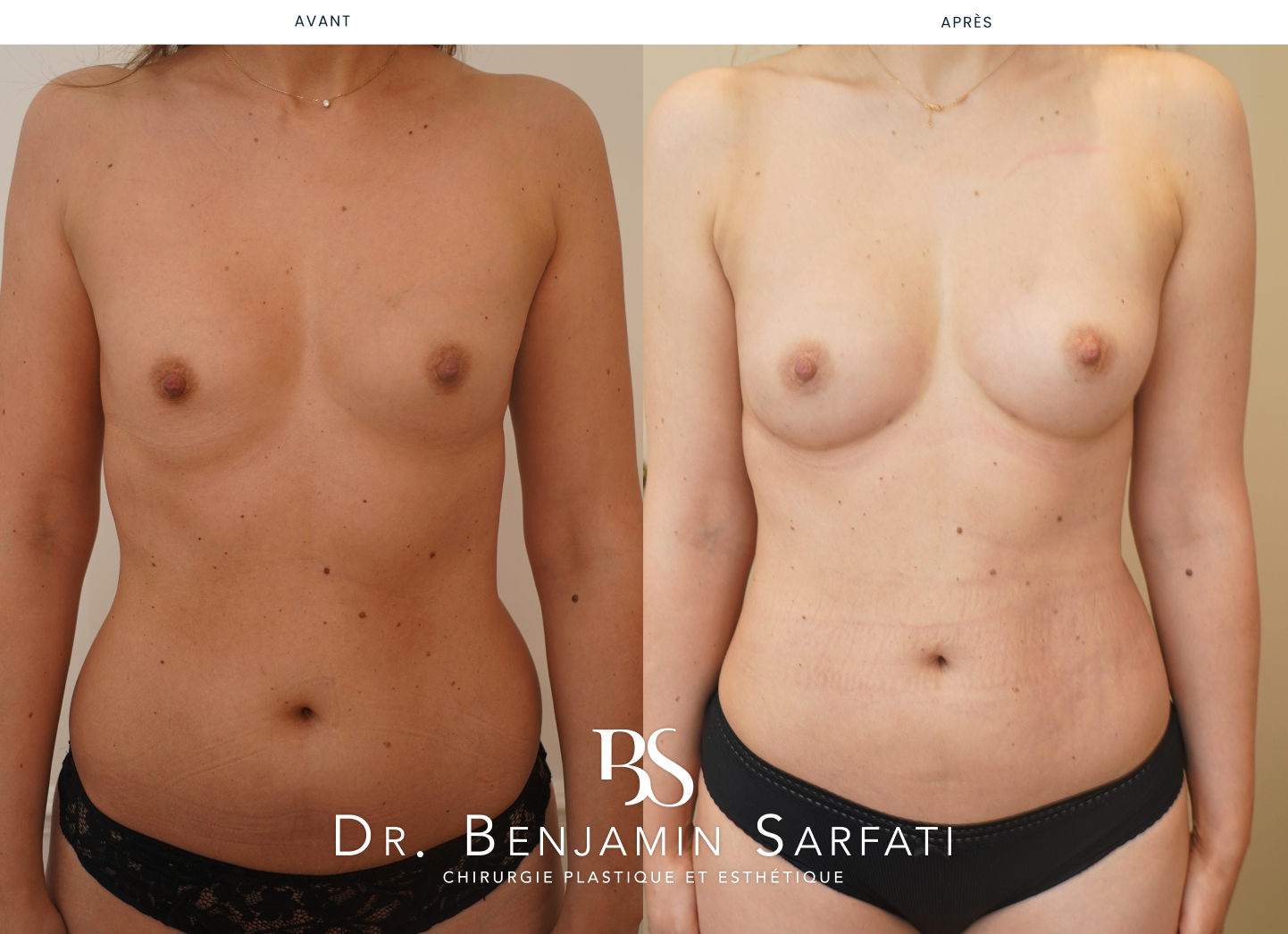 Breast augmentation by lipofilling