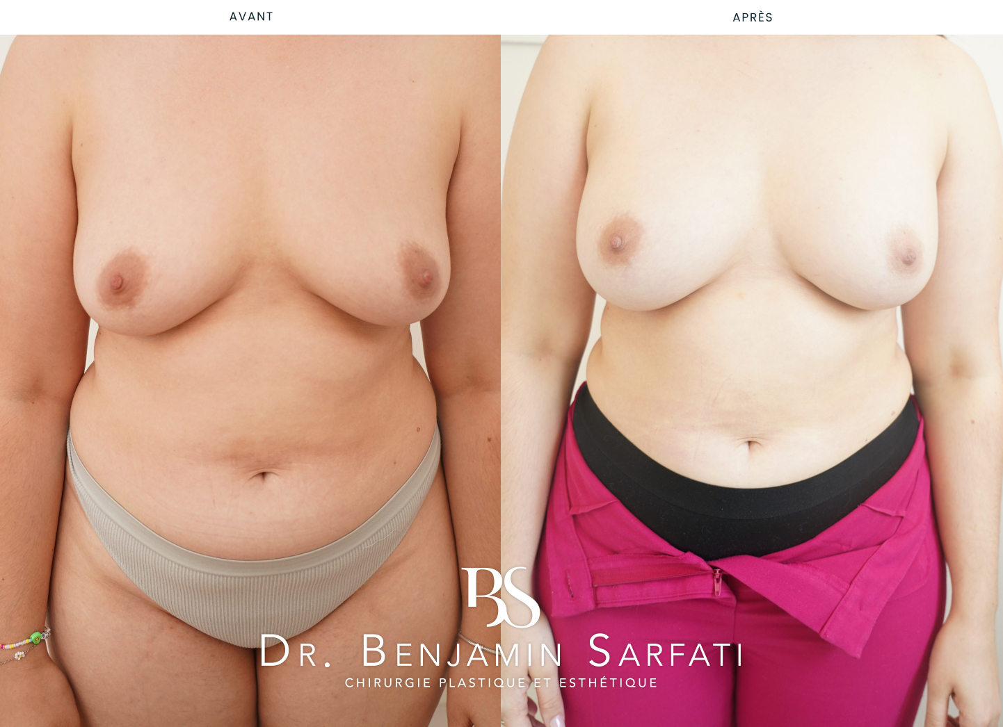 Breast augmentation with implants