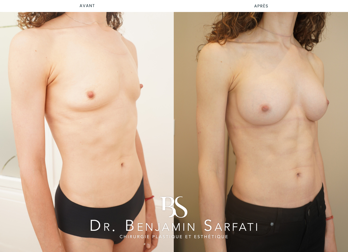 Breast augmentation with implants