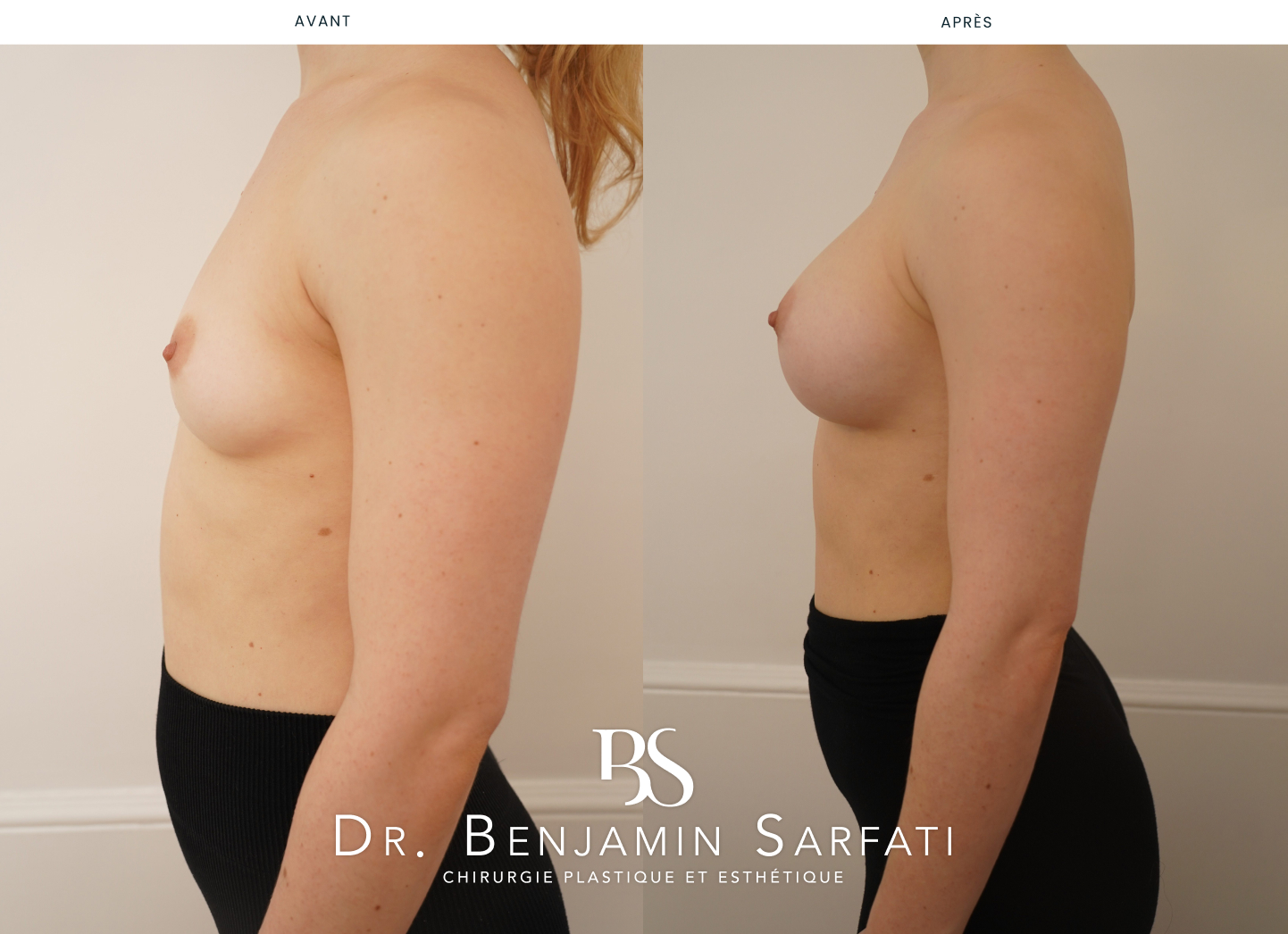 Breast augmentation with implants