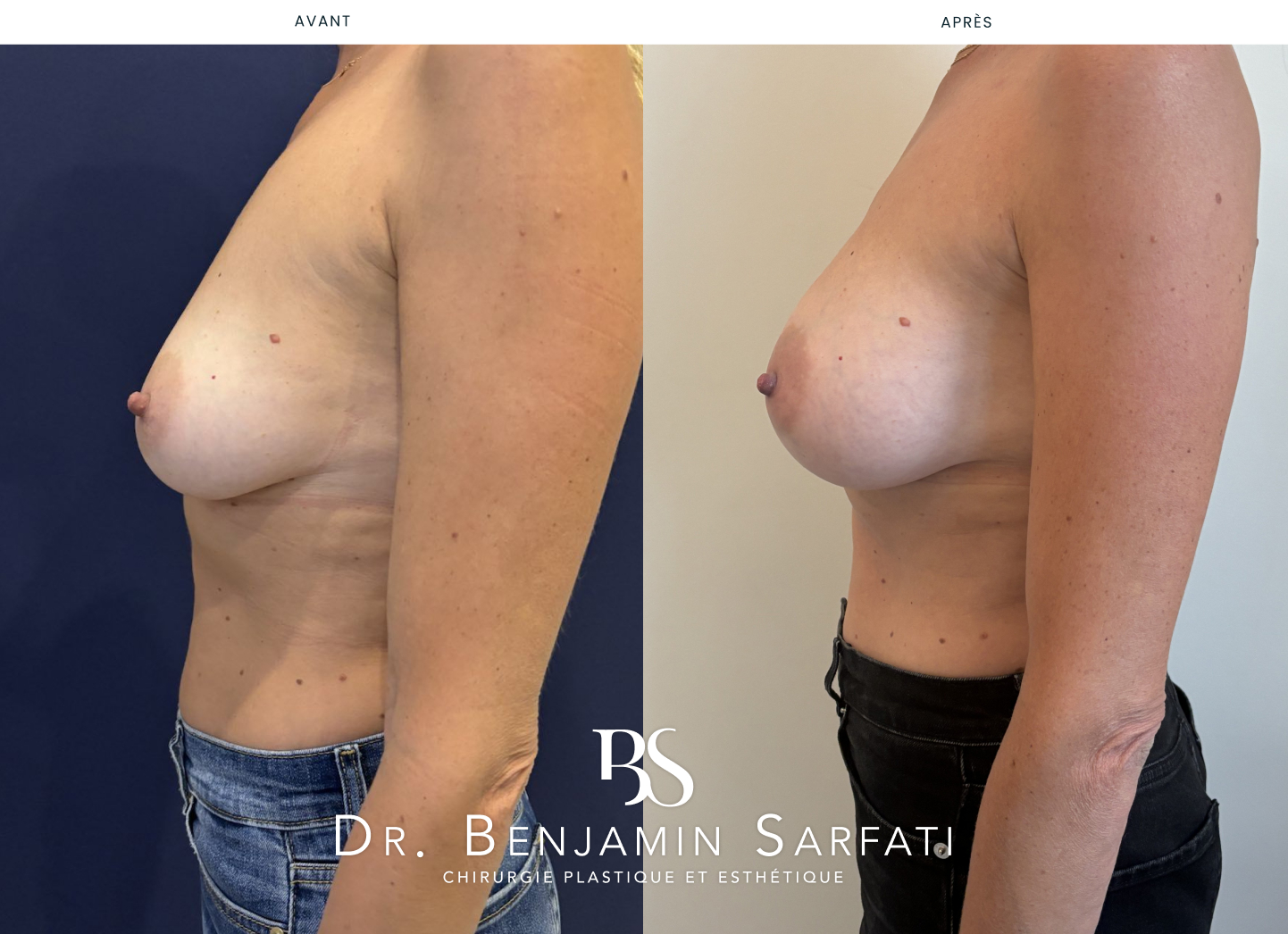 Breast augmentation with implants