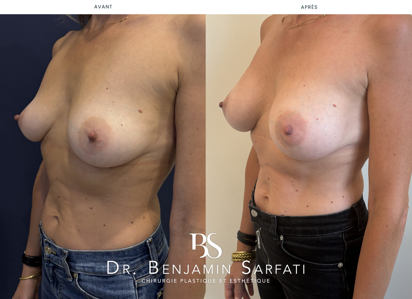 Breast augmentation with implants