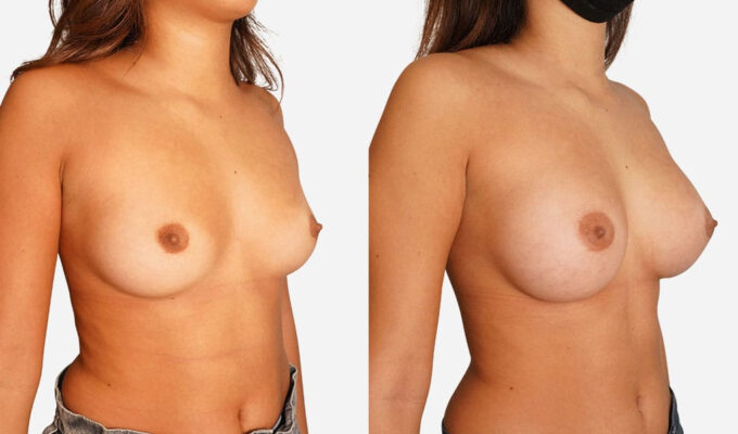 Poitrine avant et après augmentation mammaire par prothèse et cicatrices sous mammaire Dr Benjamin Sarfati Paris