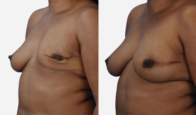 Poitrine avant et après une reconstruction mammaire total du sein gauche par injection de graisse Dr Benjamin Sarfati paris